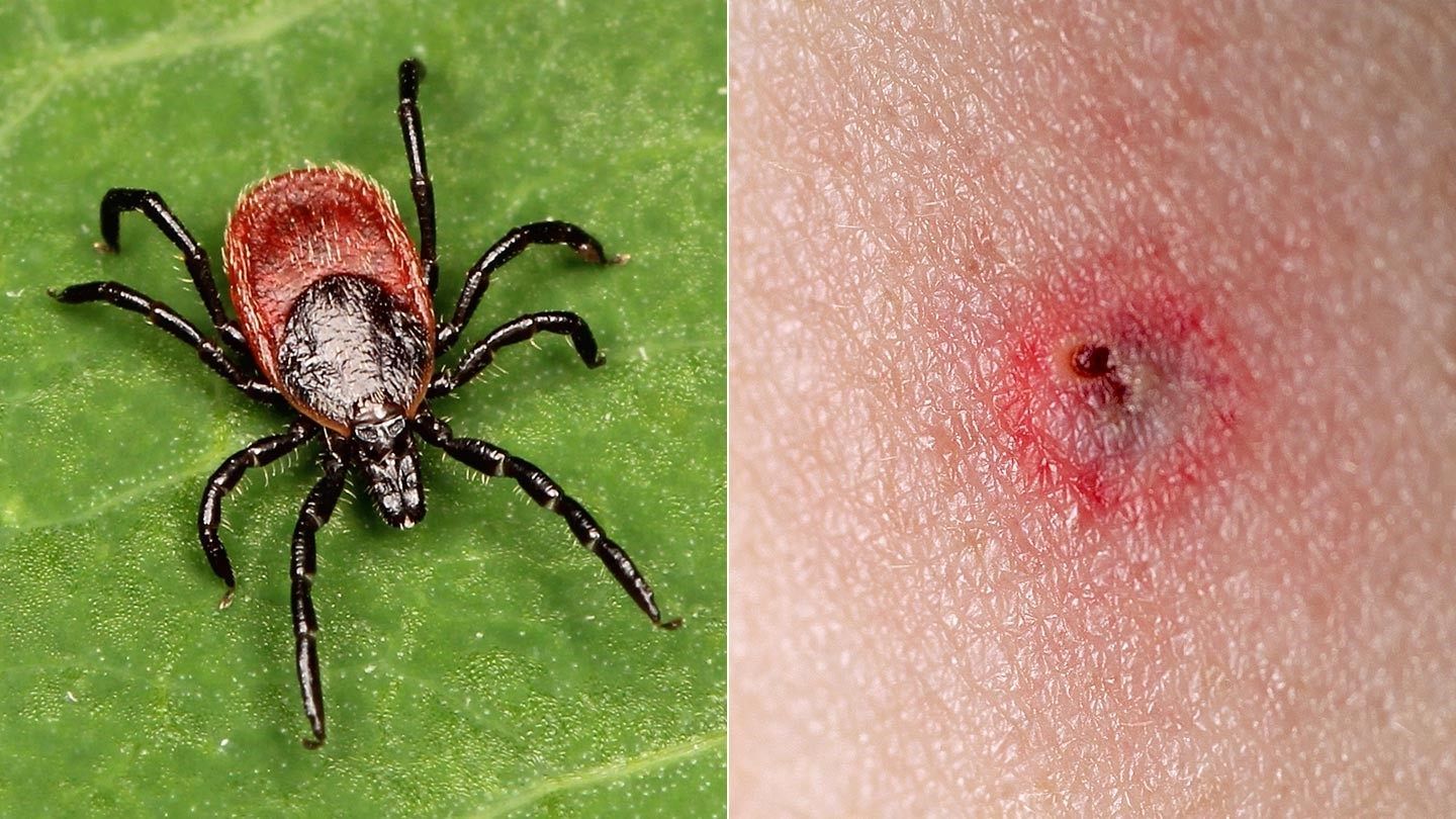 Tick bite蜱虫叮咬后得莱姆病的几率到底有多高？